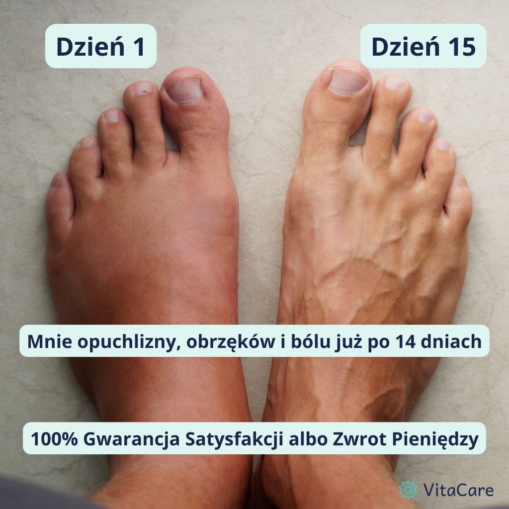 VenoCare Plus® - Białe Skarpety Kompresyjne - VitaCare - 